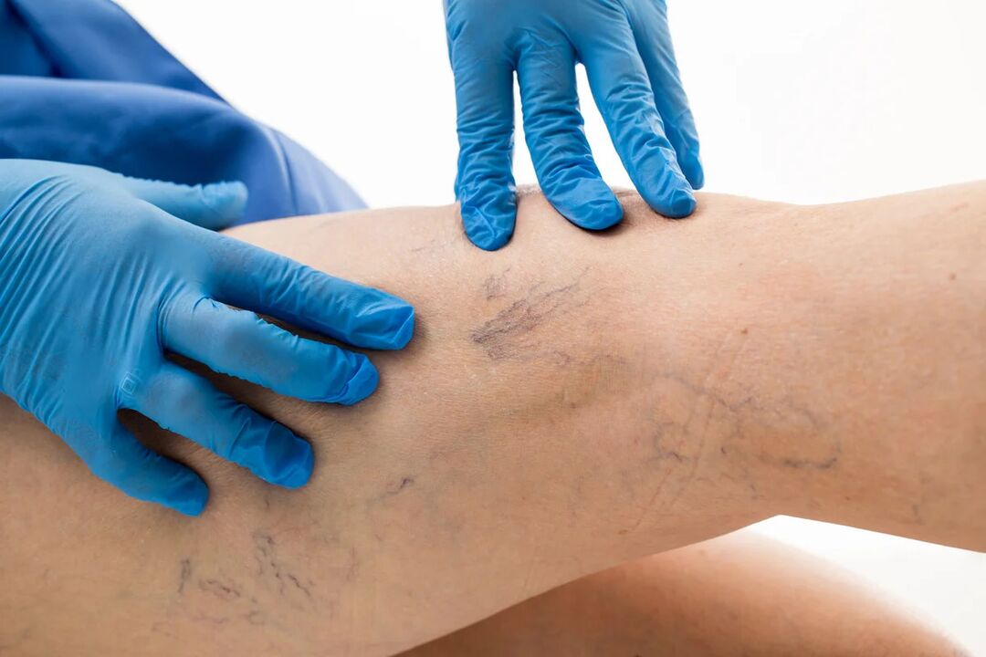 Varices net