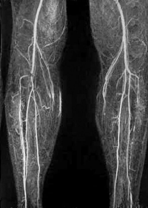 Vascular x -ray