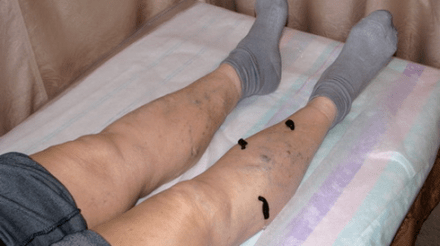 tratamento de varices con sanguijuelas