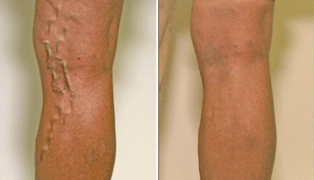 varices nas fases 1 e 3 do desenvolvemento