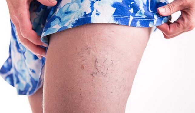 varices
