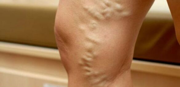 varices nas pernas das mulleres