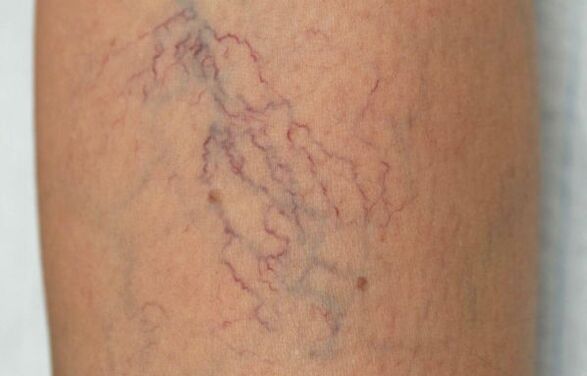 varices nas pernas nas mulleres