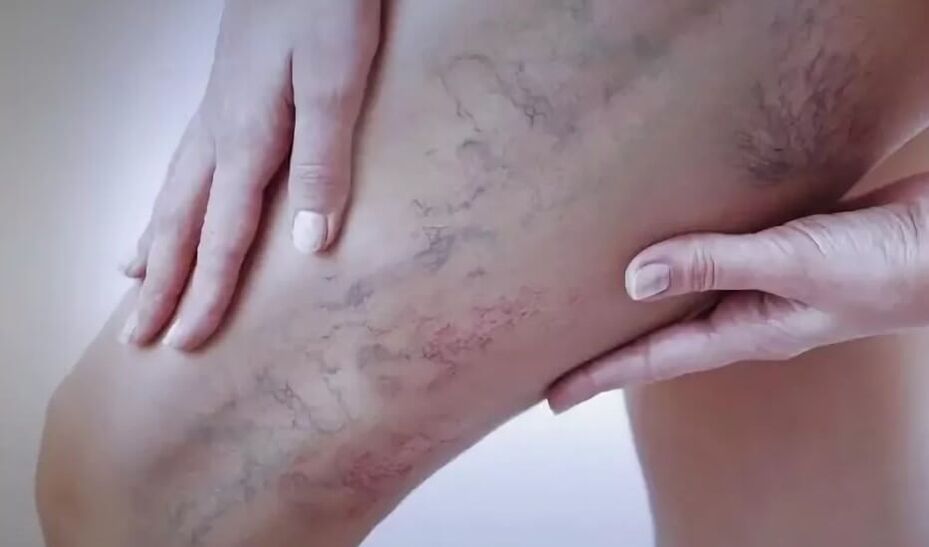 Estrelas nas pernas con varices