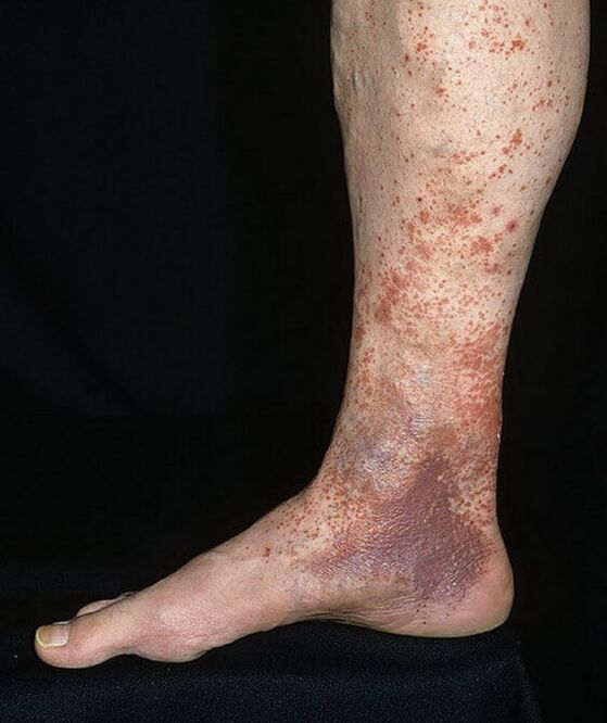 Varices de dermatite