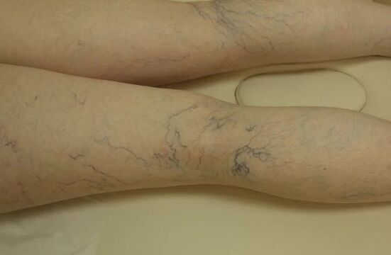 Varices estrelas nas pernas