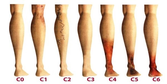 etapas do desenvolvemento de varices nas pernas
