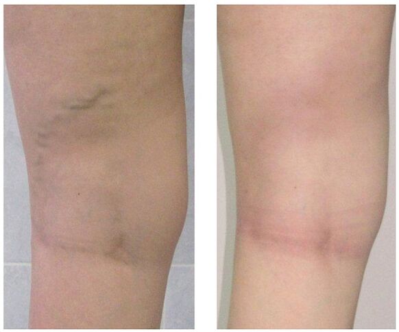 vea na perna antes e despois do tratamento de varices