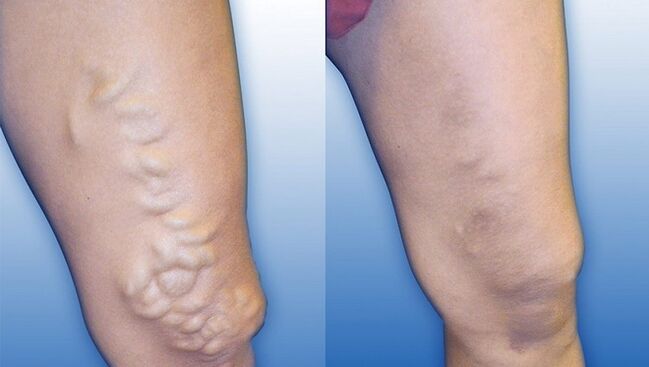 Pernas antes e despois do tratamento de varices graves