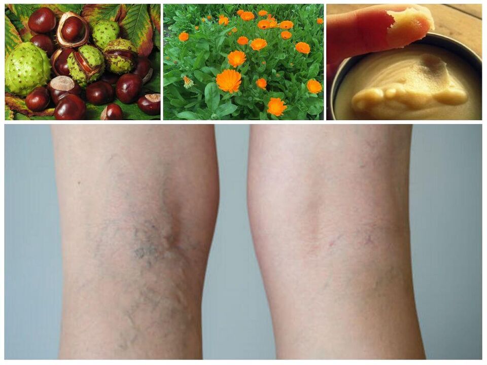 varices nas pernas e remedios populares para a súa prevención
